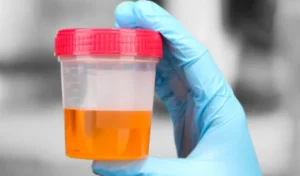 Scientists develop urine test that detects bladder cancer with 95% accuracy 2 Urine test